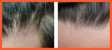 Лечение волос до и после