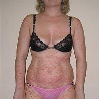 от псориаза